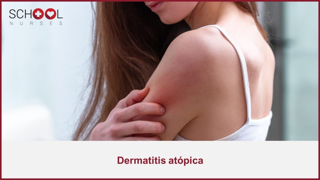 Qué es la dermatitis atópica